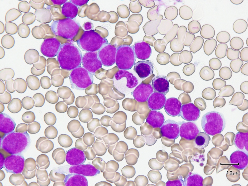 Acute myeloid leukemia cells 