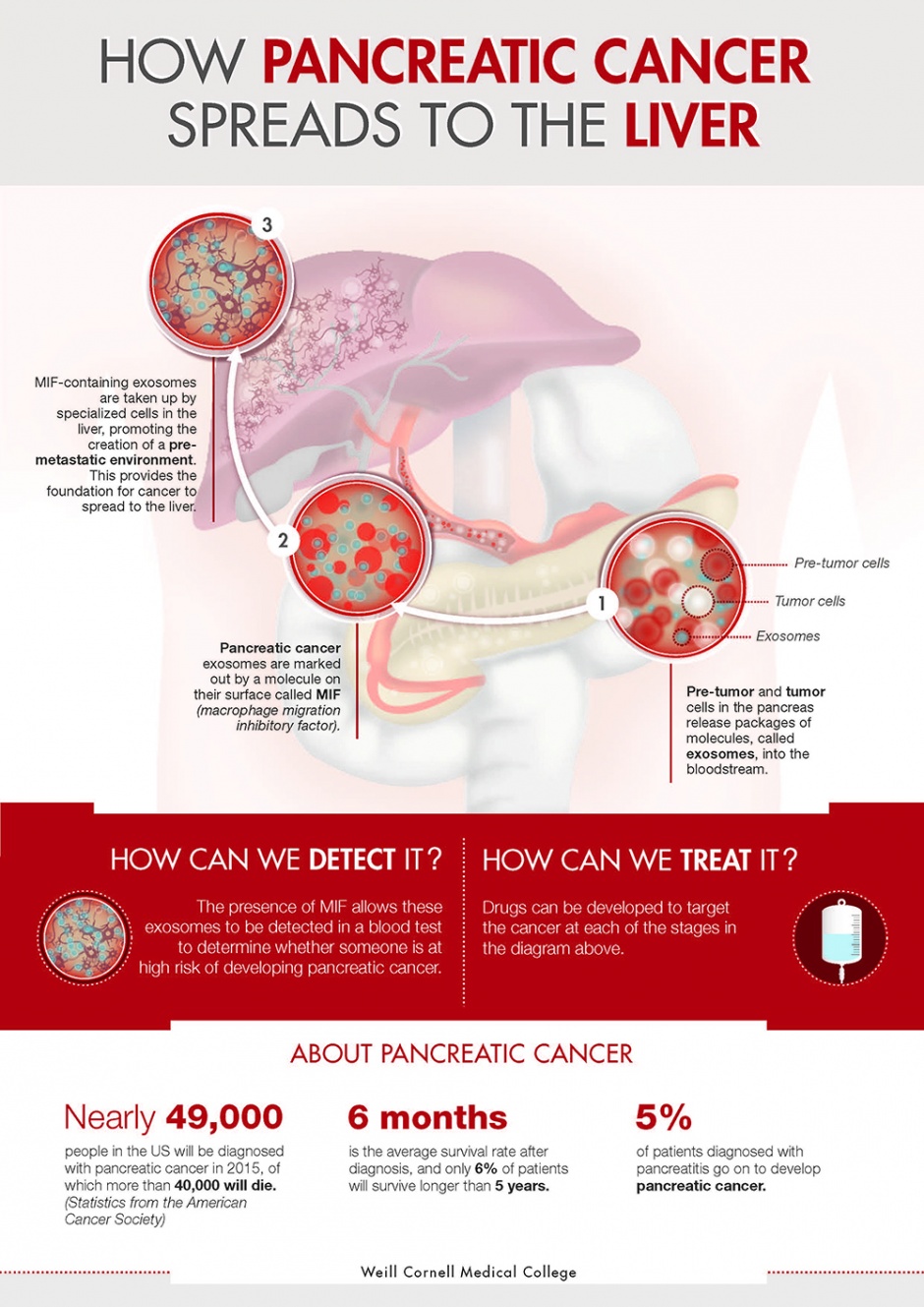 Infographic of pancreatic cancer spread