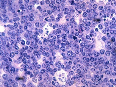 Cell image of Burkitt's lymphoma