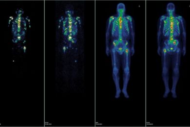 Imaging after treatment with Radiolabeled PSMA molecule (images on the left) show specific targeting to multiple metastatic lesions in the bone which are seen on radionuclide bone scan (depicted on the right).