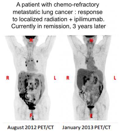 One cancer patient treated with radiation in combination with immunotherapy achieved remarkable results