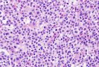 Blood cancer cells