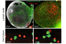 image of CAR-T cells and lymphoma cells in the lymph node and cell culture