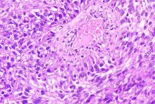 scientific image of kidney cancer, colored in purple