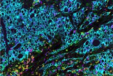 Human lung cancer cells stained for various surface markers