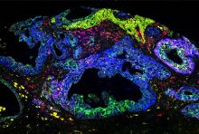 immunofluorescence image of pancreatic cancer cells labeled in various colors