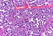 lymphoma cell