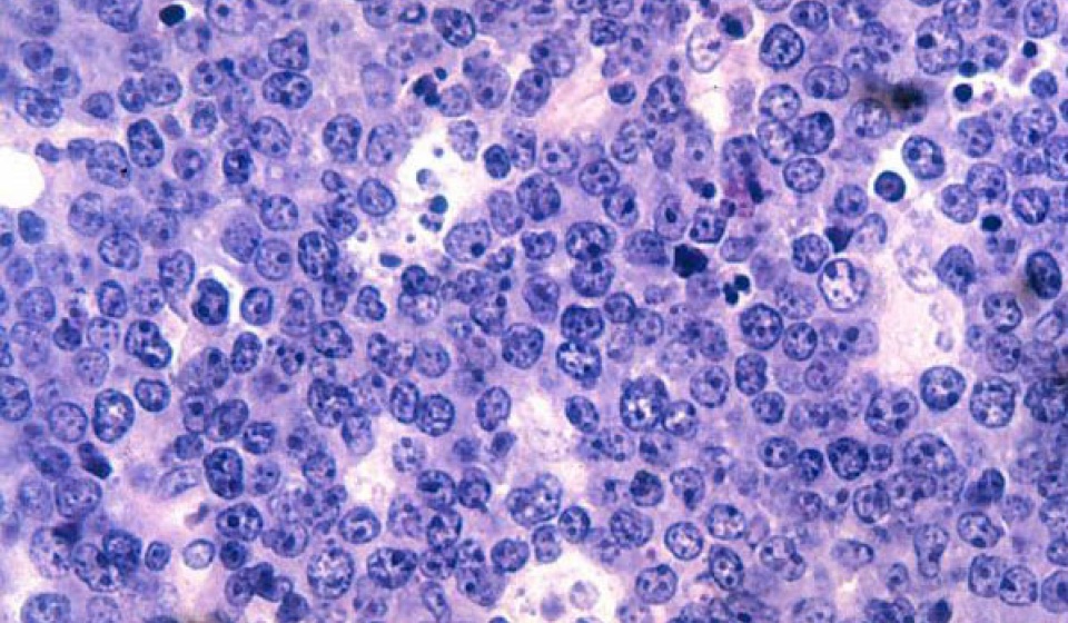 Immunotherapy is an exciting new frontier in blood cancers like lymphoma
